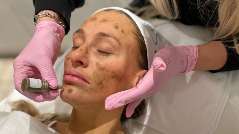 Bio microneedling spicule solution applied to face