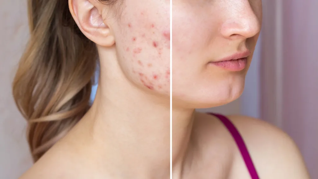 Learn about acne scars and texture treatments with Secret RF vs Potenza.