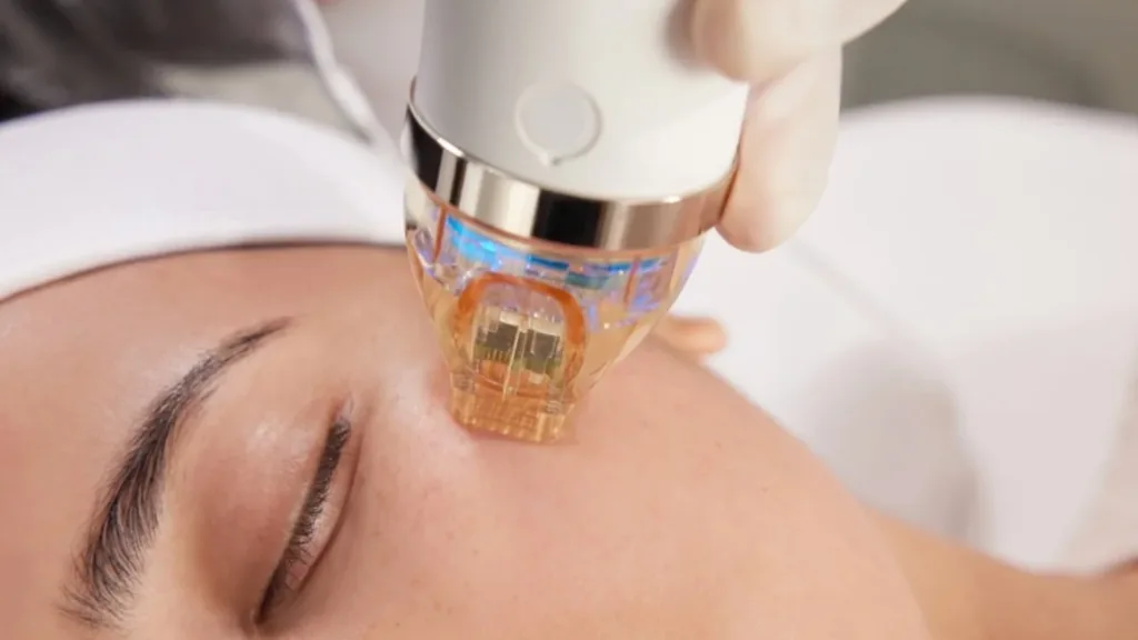 Good candidate for secret rf micro needling. 