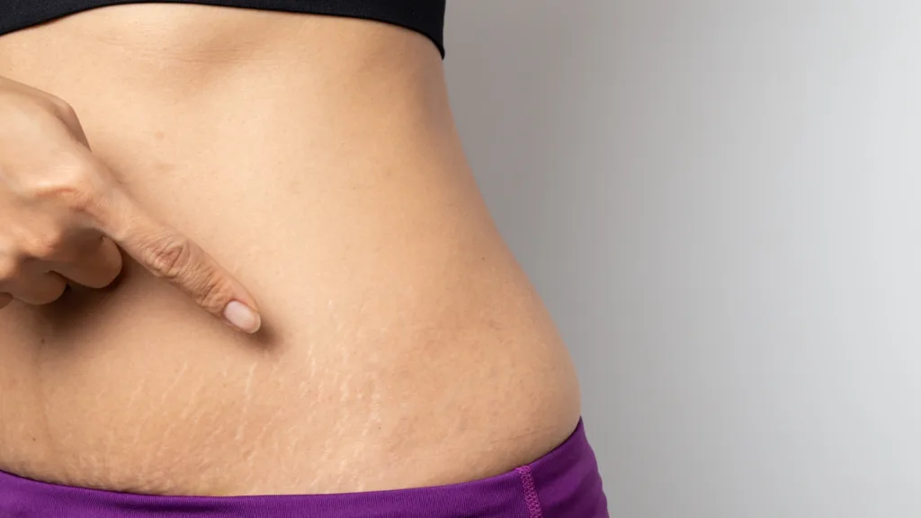 Know-about-secret RF for stretch marks treatment with advanced skin rejuvenation technology. 