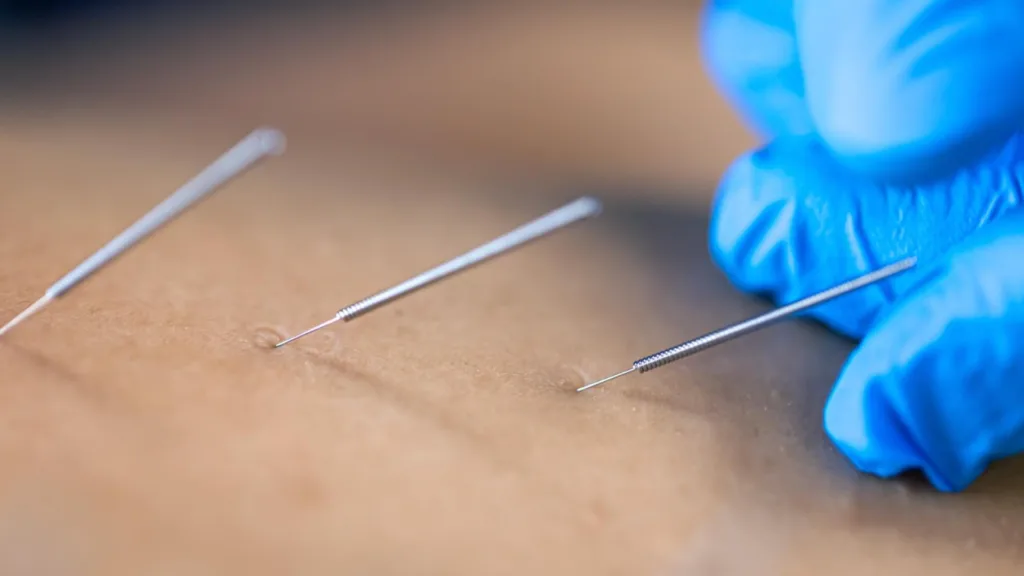 Skin treatment insights comparing potenza vs secret rf for needle depth and precision.