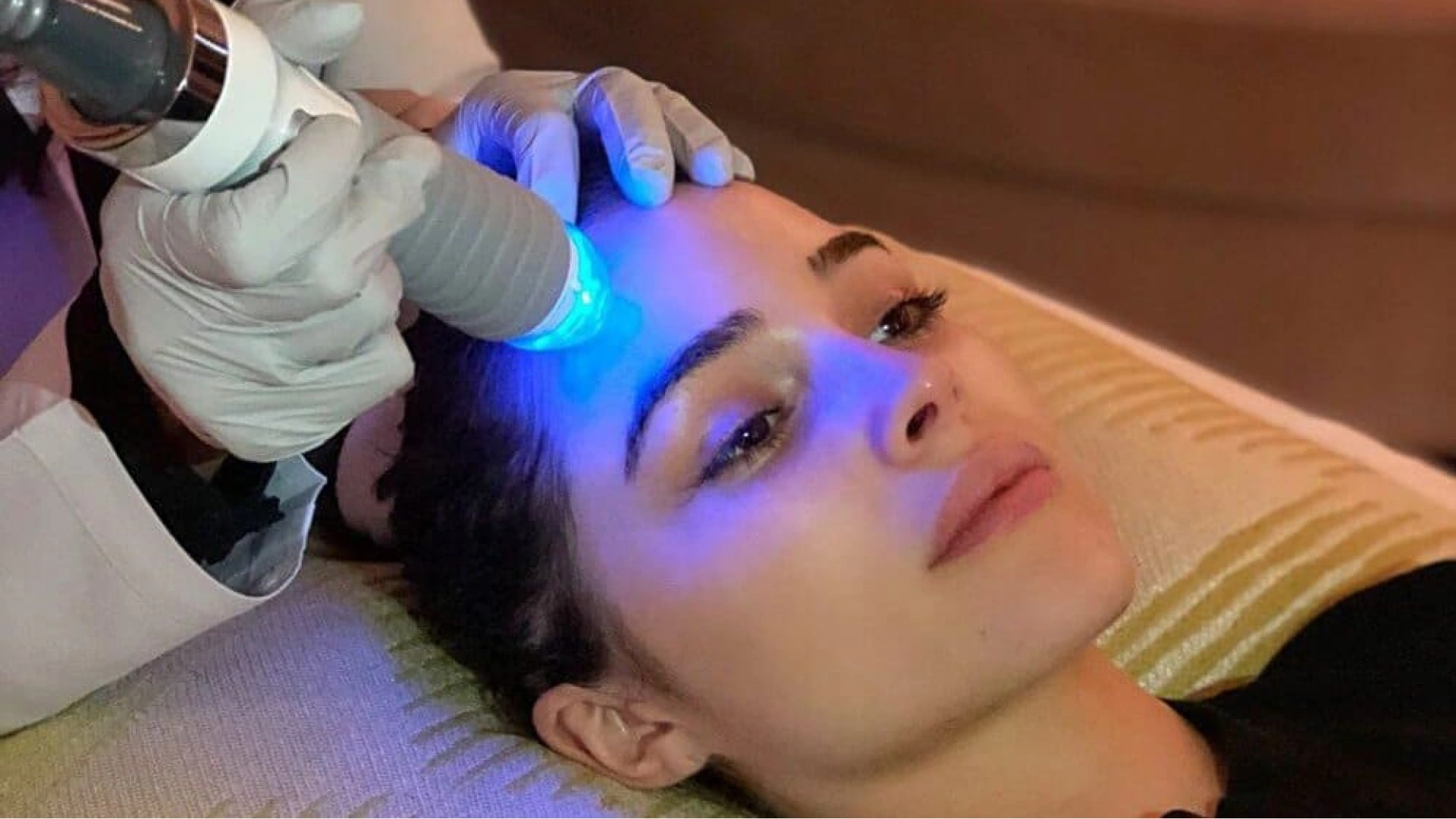 RF micro needling radio frequency before and after importance.