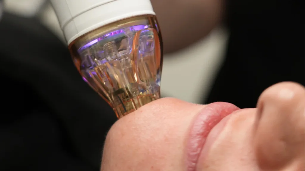 Secret RF micro needling treatment with hydration and sun exposure care tips for healthier-looking skin.