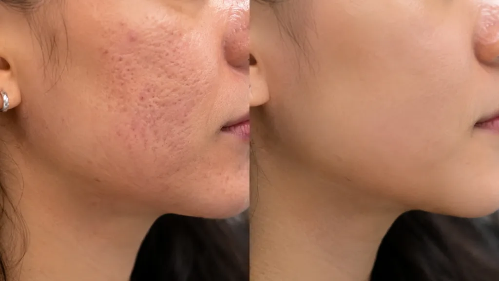 Acne scars treatment options with Secret RF vs Vivace. 