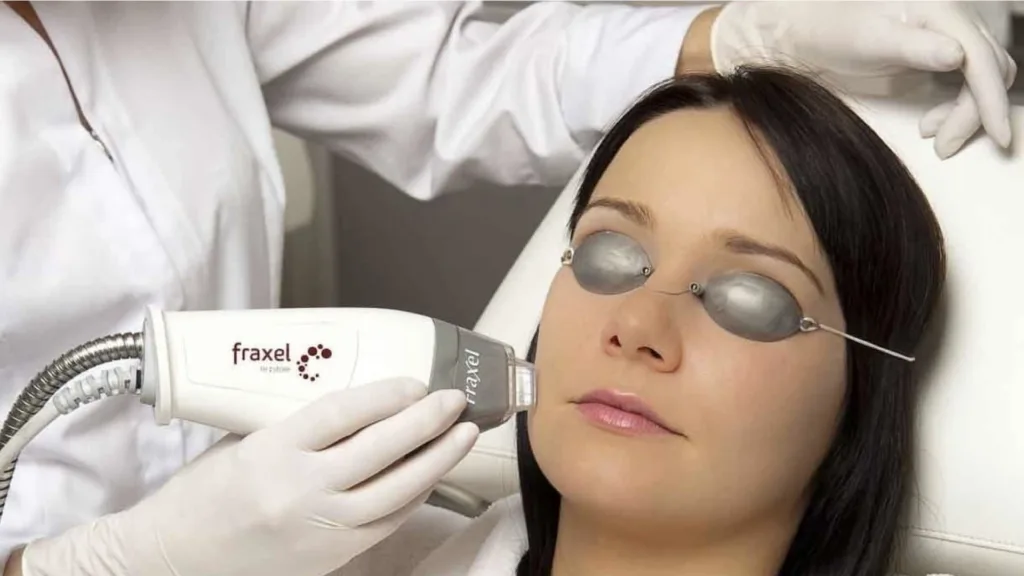 Combining fraxel and rf microneedling secret rf vs fraxel.