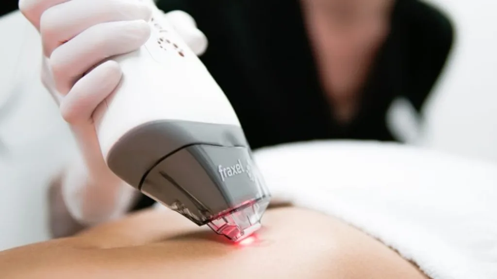 Secret RF vs Fraxel treatment considerations for lighter skin tones.