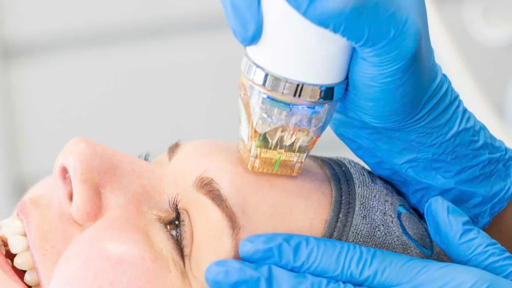 Know what is Secret RF and Secret RF vs Scarlet RF treatment comparison.