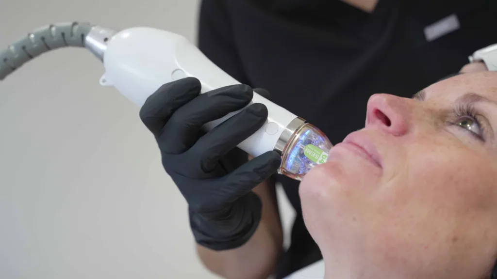 Large pores and skin smoothing treatment comparison with secret rf vs fraxel.