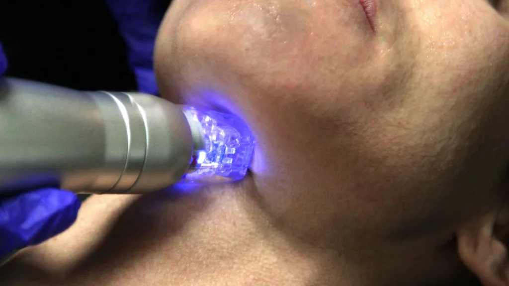 Learn what is Scarlet RF and Secret RF vs Scarlet RF treatment comparison.
