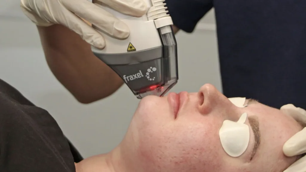 Secret RF vs Fraxel treatment comparison for pigmentation and redness.