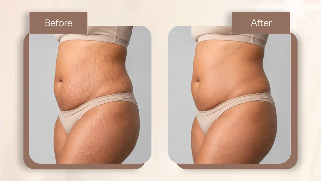 Secret RF before and after stretch marks treatment results.