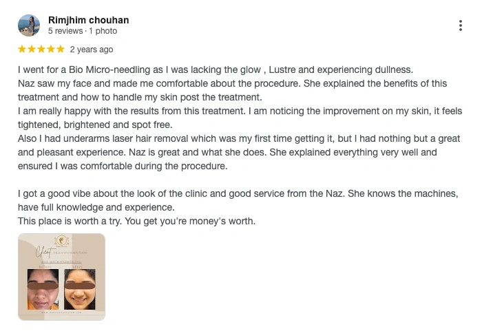 Common positive reviews highlighting Secret RF microneedling results.