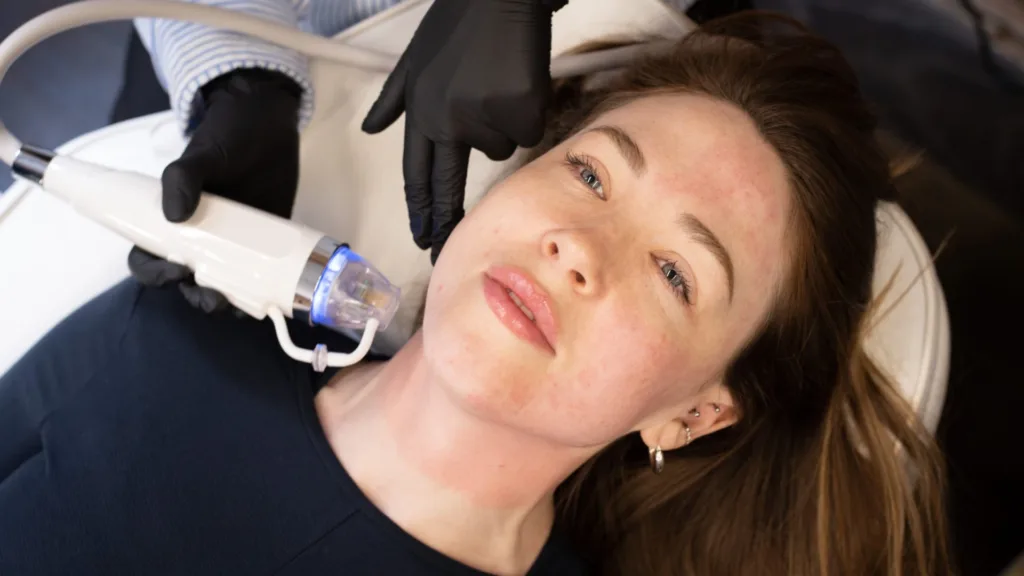 Secret RF post treatment redness, warmth and mild swelling.