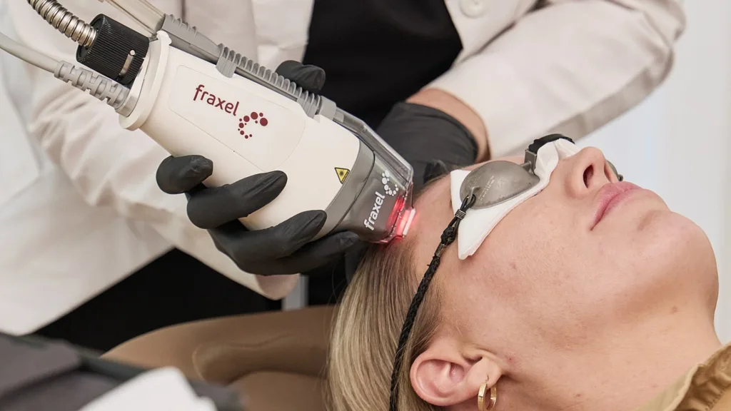 Secret RF vs Fraxel treatment for acne scars and skin texture improvement.
