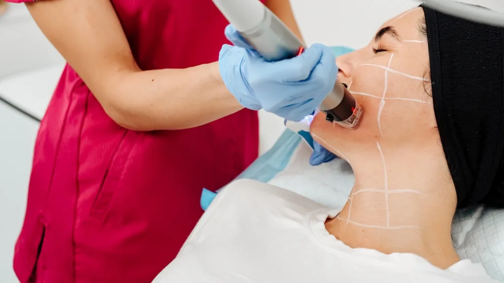 Secret RF vs Genius RF treatment suitability for different skin types. 