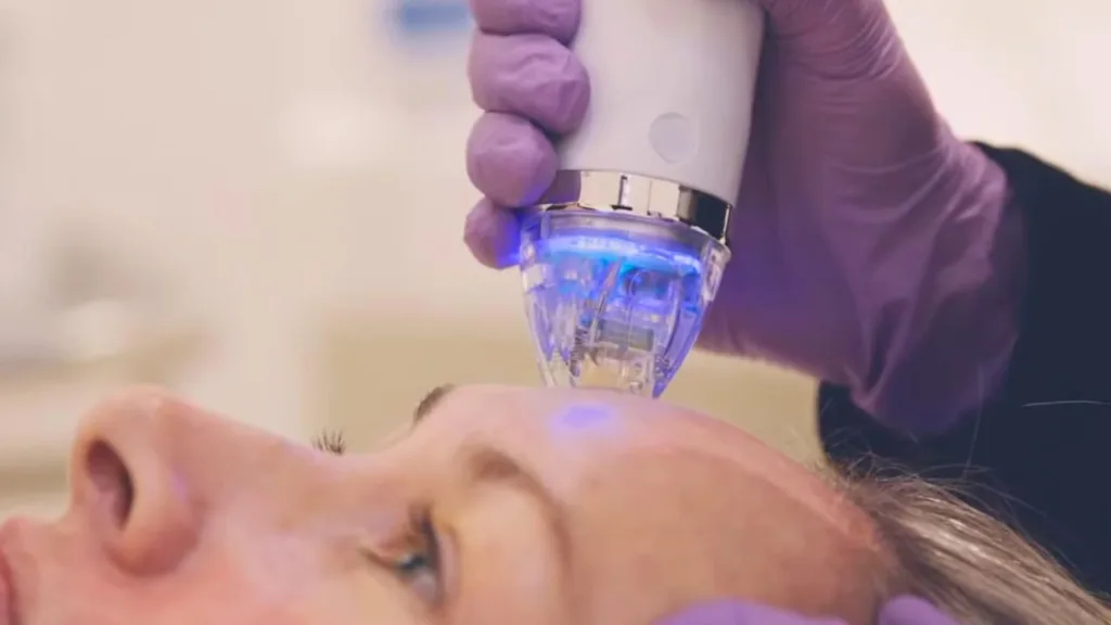Secret RF vs Genius RF treatment areas for skin rejuvenation. 