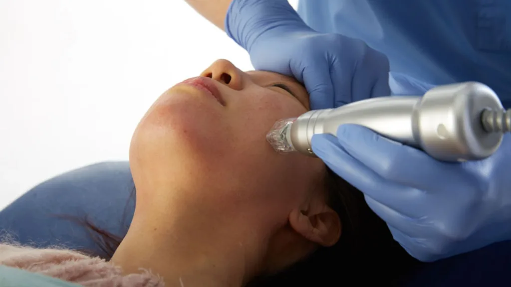 Know what to expect during the Secret RF vs Scarlet RF treatment procedure.