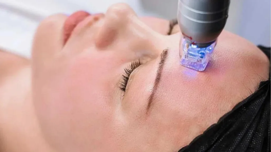 Secret RF vs Scarlet RF treatment areas and skin rejuvenation options.
