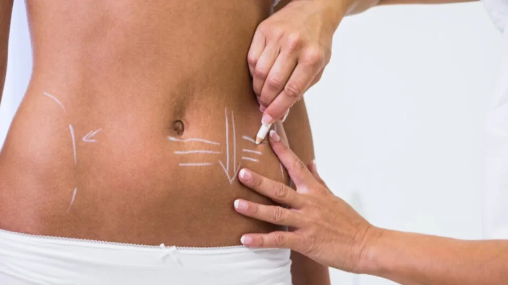 Secret rf vs venus viva for skin laxity and stretch marks.