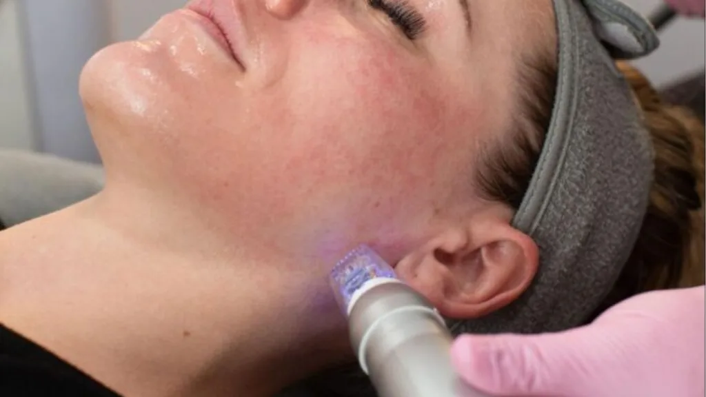 Secret RF vs Scarlet RF for skin tightening and laxity treatment.